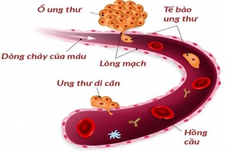 TÌM HIỂU VỀ UNG THƯ DI CĂN